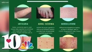 Doctor Skin rash could be a symptom as possible COVID19 symptom [upl. by Eladnwahs]