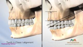 Malocclusion  Overjet Overbite Secondary to Vertical Maxillary Excess [upl. by Seve]