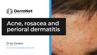 Acne Rosacea and Perioral Dermatitis [upl. by Sorrows160]