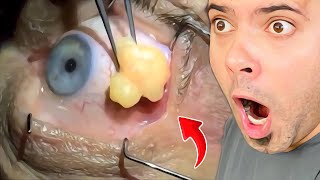 Popping huge blackheads and Giant Pimples Best Pimple Popping Videos [upl. by Yelyk]