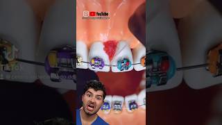 Braces Flossing Hack [upl. by Terrence]