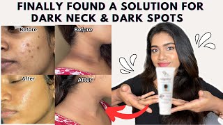 Dark neck amp Hyperpigmentation treatment  Acanthosis Nigricans treatment [upl. by Nolita]