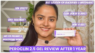 Blackheads Whiteheads amp Comedones Treatment In 15 Days😱  Peroclin 25 Gel Review😶  Soni Mishra [upl. by Lennie]