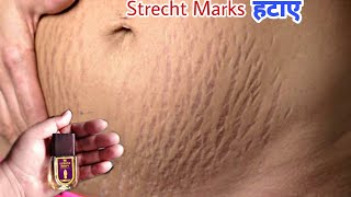 सिर्फ मिनटों में Strech Mark पर इतना कमाल का असरदुनिया पूछने लगेगीलगाया क्या था Nuskha [upl. by Madelyn]