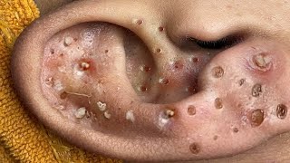 Big Cystic Acne Blackheads Extraction Blackheads amp Milia Whiteheads Removal Pimple Popping  3391 [upl. by Arbrab]