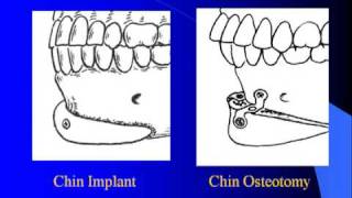 Large Chin Augmentation with Dr Barry Eppley [upl. by Hampton225]