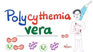 Polycythemia Vera PV  Myeloproliferative Neoplasm MPN  Erythrocytosis  Hematology [upl. by Essilevi]