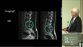 Spondylolysis amp Spondylolisthesis  Wally Krengel MD [upl. by Sheya]