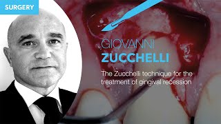 Prof Dr Giovanni Zucchelli’s technique for the treatment of gingival recession [upl. by Yznil]