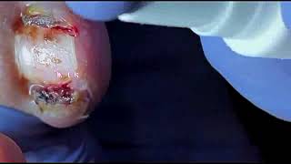 DIY Ingrown Toenail Removal  How to Safely Cut Ingrown Toenails at Home [upl. by Nedle]