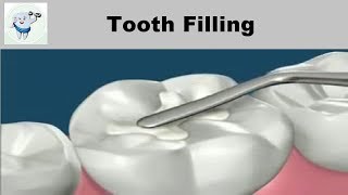 Tooth Cavity Filling [upl. by Ellenahs]