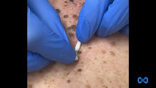 Large Blackheads on the Back [upl. by Devehcoy]