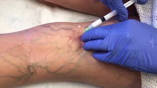 Watch This Vein Disappear  Sclerotherapy Vein Removal [upl. by Rondi835]