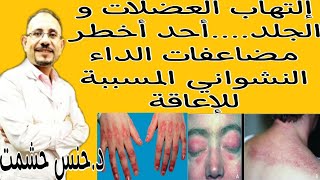 ما يجب معرفته عن Dermatomyositis الناتج عن الداء النشوانيأسبابأعراضعوامل الخطرمضاعفاتتشخيصعلاج [upl. by Demeyer]