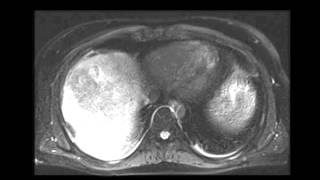 Large hepatocellular carcinoma HCC [upl. by Butterworth574]