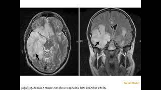 17 Limbic encephalitis antiNMDA paraneoplastic herpes encephalitis HSV1 HHV6 MRI [upl. by Damour]