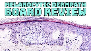 Melanocytic Dermpath Board Review melanoma blue nevus other nevi amp mimics pathology dermatology [upl. by Dloreh]