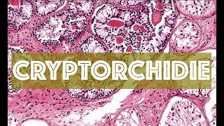 LA CRYPTORCHIDIE  PATHOLOGIE [upl. by Nevetse]