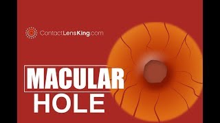 Macular Hole What Causes it and What are its Symptoms [upl. by Eliathan]