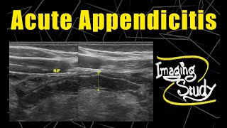 Acute Appendicitis  Ultrasound  Case 104 [upl. by Ahsaetal]