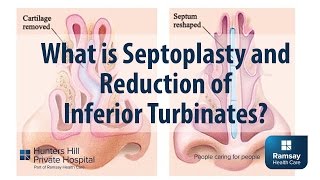 What is Septoplasty and reduction of Inferior Turbinates [upl. by Imrots]