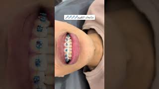 drteethdento اكسبلور dentist genshinimpactmusic ترند automobile classicalmu تجميل [upl. by Angadresma981]