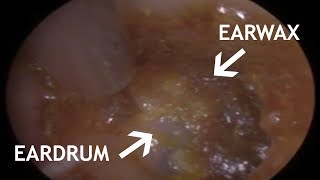 EARDRUM EAR WAX REMOVAL  STEADY HAND PREREQUISITE  439 [upl. by Licastro]