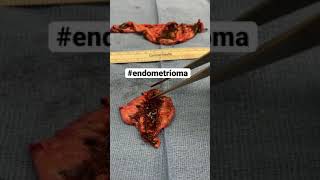 Endometrioma cysts endometriosis [upl. by Gad]