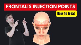 HowTo Treat The Frontalis With Botox  Dr Chris Hutton Aesthetics Training [upl. by Agretha395]