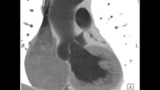 Cardiac Dilated aortic root and sinuses of Valsalva 6 of 10 [upl. by Lori203]