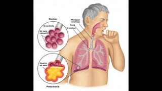 Probiotics Bifidobacterium Breve amp Lactobacillus Rhamnosus Helps Asthma  Inflammation T cell [upl. by Hilbert]