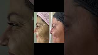 Toxina botulínica para rejuvenescimento harmonizacaoorofacial botox toxinabotulinica [upl. by Akila]