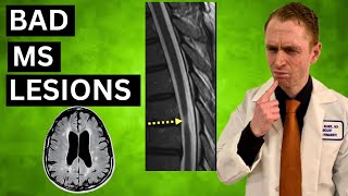 Bad MS MRI Lesions [upl. by Ahsiele]