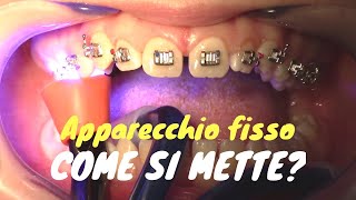 Come si mette lapparecchio fisso [upl. by Meesan950]