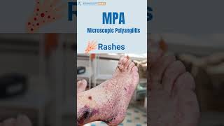 MPA Vasculitis Microscopic Polyangiitis Signs  You Should Not Ignore [upl. by Sager]