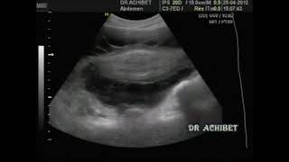 Ascite tuberculeuse Dr ACHIBET [upl. by Welby]