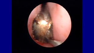 Button Battery In The Nose Resulting in Caustic Burn [upl. by Yleoj]