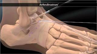 Bandrekonstruktion bei chronischer Instabilität des Sprunggelenkes  Arthroscopic Broström [upl. by Lilybel]