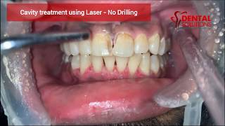 Tooth cavity filling without drilling  Laser caries treatment  Contactless cavity filling [upl. by Seaton]