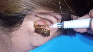 The Most Massive Earwax Removed in One Scoop [upl. by Christiansen]