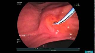 Choledocholithiasis  Sphincterotomy and Stone Extraction with a Basket [upl. by Madelle895]