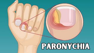 Paronychia  Causes Risk Factors Signs amp Symptoms Treatment  Everything You Need To Know [upl. by Damal269]