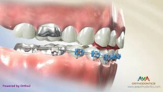 Orthodontic Treatment for Deepbite  Fixed Bite Plate on Front Teeth [upl. by Allegna]