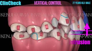 Invisalign Extraction Class II div 2 Deepbite【インビザライン抜歯 過蓋咬合】 [upl. by Roscoe636]