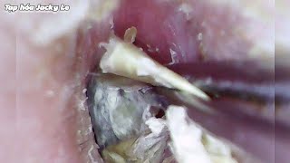 Ear Wax Removal 110 Itching All Day Because Of Dry And Thick Earwax  Ear Cleaning ASMR [upl. by Ilyse]