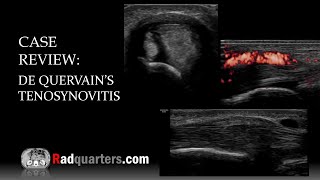 Ultrasound of de Quervain’s Tenosynovitis [upl. by Llevram260]