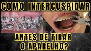 Como fazer a intercuspidação antes de remover o aparelho ortodôntico Aula 211 [upl. by Ilime]