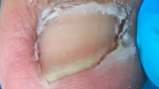 Thick dead skin stuck to toes gentle cleansing Pedicure [upl. by Keese]