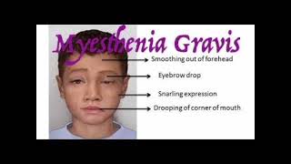 Myasthenia gravis mrcpch Clinical [upl. by Broder]