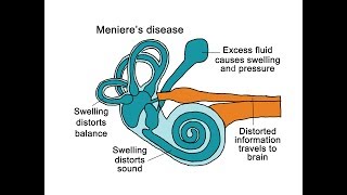 Menieres Disease [upl. by Brooks185]